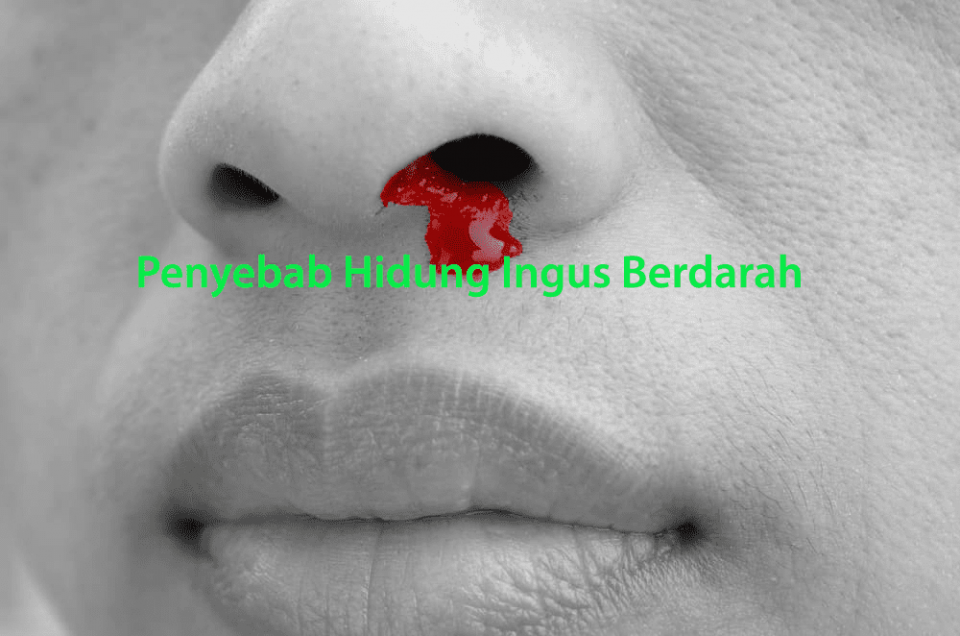Penyebab Hidung Ingus Berdarah